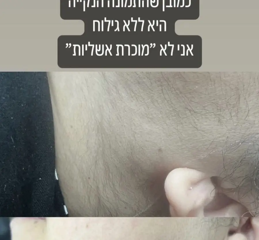 תוצאת טיפול לייזר — שיער פלומתי · פנים