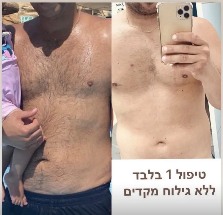 תוצאת טיפול לייזר — חזה + בטן · גבר