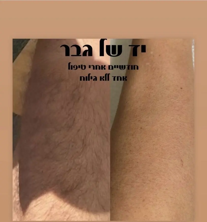 תוצאת טיפול לייזר — בית שחי · גבר