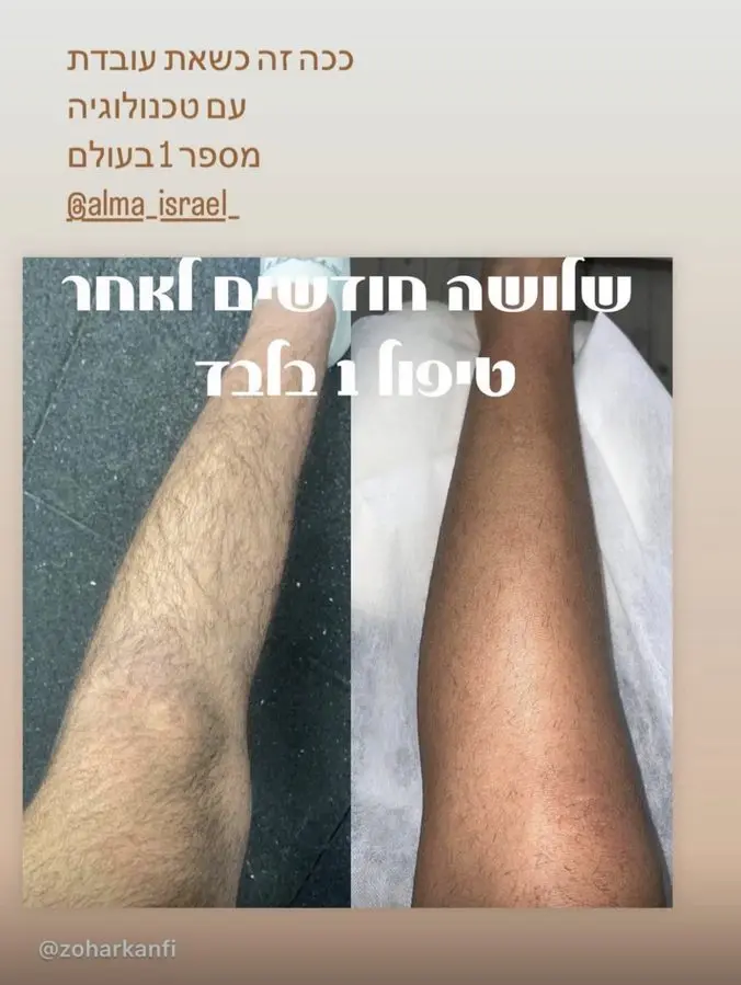תוצאת טיפול לייזר — רגליים · גבר